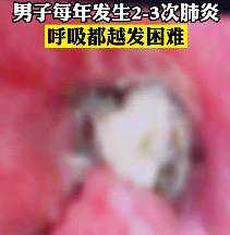 男子啃鸭脖骨头卡进肺部，居然20年后才发现